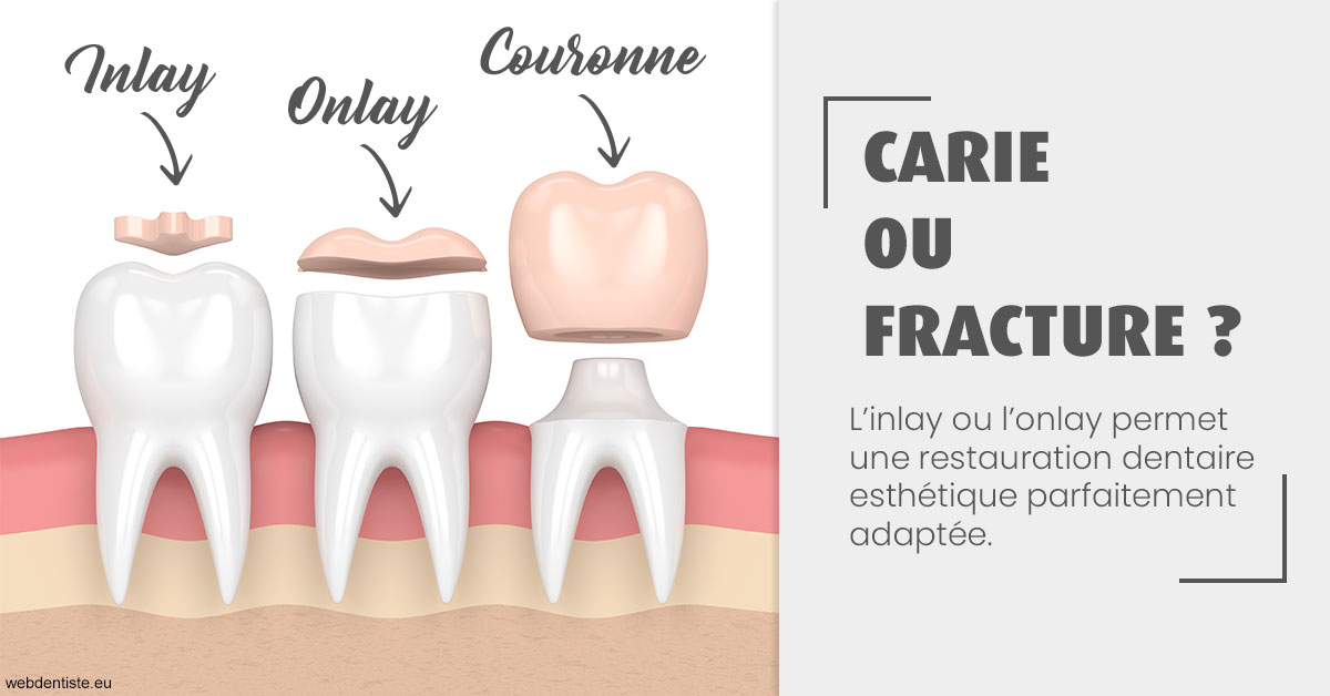 https://www.dr-deck.fr/T2 2023 - Carie ou fracture 1