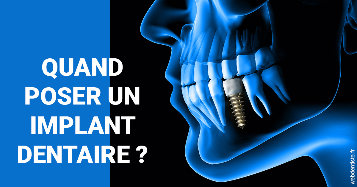 https://www.dr-deck.fr/Les implants 1