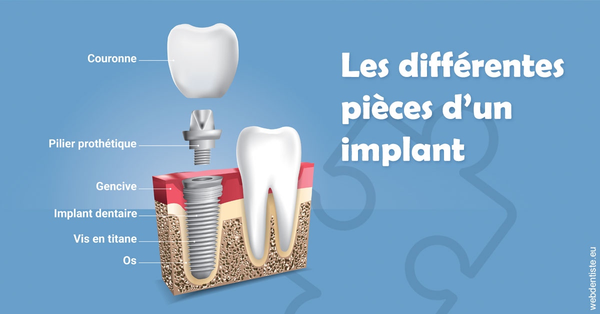 https://www.dr-deck.fr/Les différentes pièces d’un implant 1